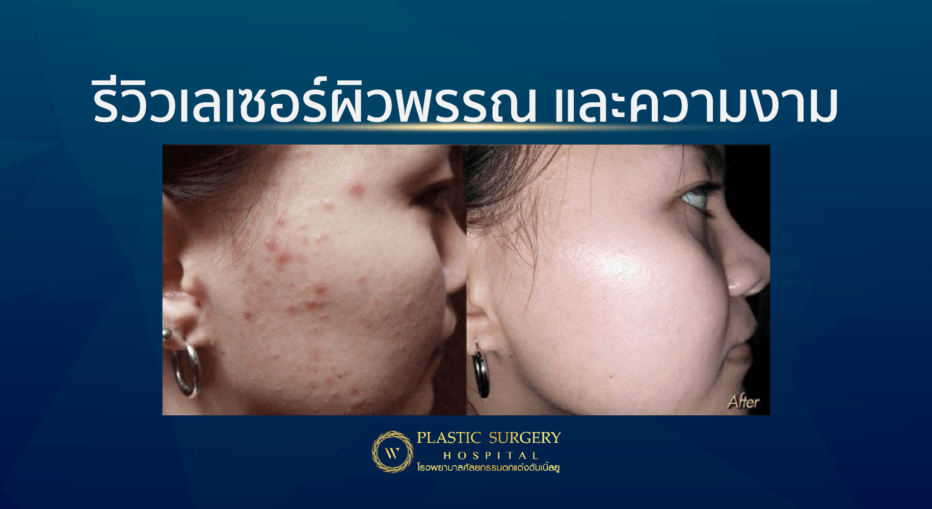 รีวิวก่อนและหลังทำ Laser